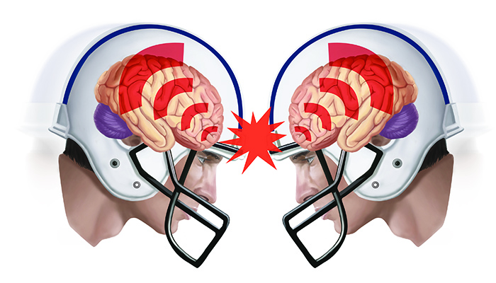 Best Sports to Play to Avoid Concussions: Safeguard Yourself Now!